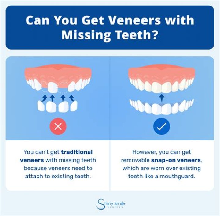 Can I get veneers if I have missing teeth?